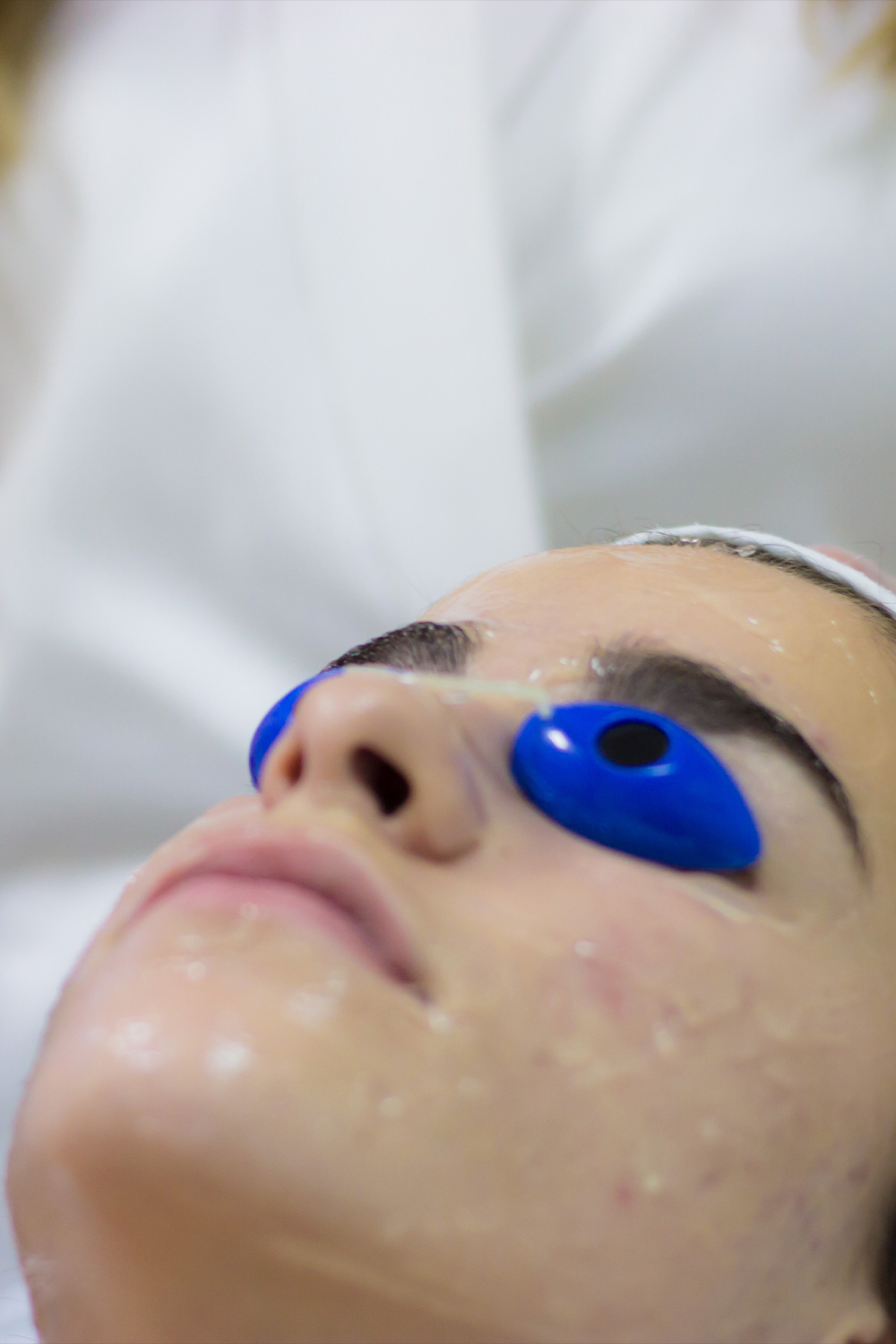 Fototerapia anti-acné