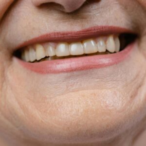 Arrugas labio superior